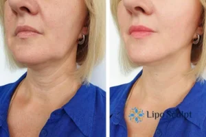 Double chin before and after Hi-Fu treatment 4 Book your double chin treatment Bletchley today! We are here to help!
