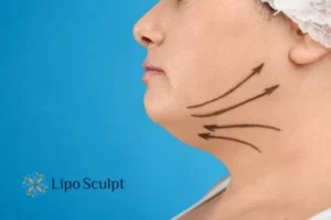 Double chin before and after Hi-Fu treatment 3 Boost your confidence with a Double chin treatment Bletchley