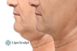 Double chin before and after Hi-Fu treatment 2 Double chin treatment Bletchley from Lipo Sculpt - feel more confident today!