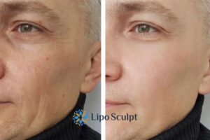 How to Fight Aging Symptoms 3 Fight Aging Symptoms Bletchley With HIFU and Morpheus8 Today!