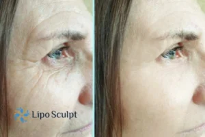 How to Fight Aging Symptoms 2 Do you want to Fight Aging Symptoms Bletchley? Contact Lipo Sculpt today!