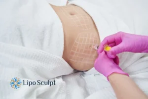 Are The Results From Aqualyx Permanent? 1 Do you want to know how long Aqualyx Bletchley results last?
