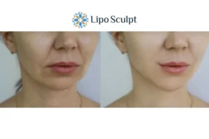 Explaining Total Skin Tightening Treatment And What It Can Do For You 2 Do you want to boost your self confidence? Give Morpheus8 Bletchley a try today!