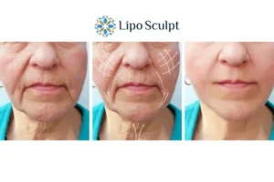 Explaining Total Skin Tightening Treatment And What It Can Do For You 3 Boost your confidence with Morpheus8 Bletchley call our team today!