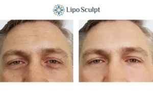 Explaining Total Skin Tightening Treatment And What It Can Do For You 6 Morpheus8 Bletchley book in today to find out more!