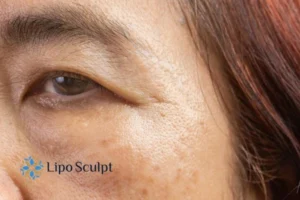 Cryopen: The Revolutionary Treatment for Age Spots Unveiled 2 Are age spots Bletchley giving you low self esteem? Contact us today!