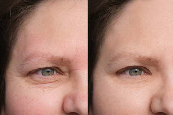 HIFU vs Botulinum Toxin: Understanding the Differences 4 How long do HIFU results last Bletchley?
