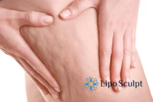 CoolSculpting for Legs: The Innovative Approach to Redefining Your Legs 5 Start your journey today book your coolsculpting treatment Bletchley online today!