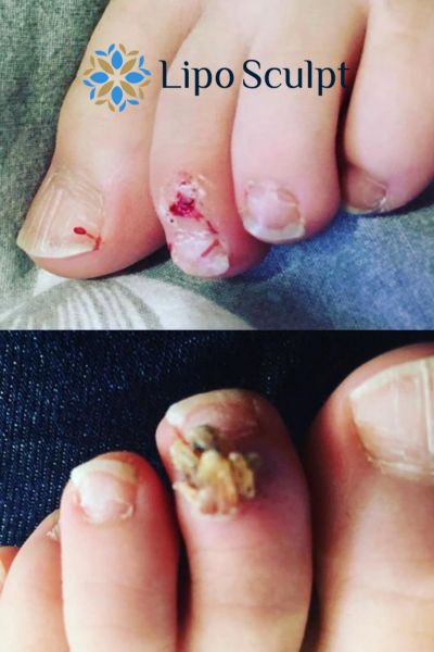 Wart removal customer results from Lipo Sculpt Bletchley