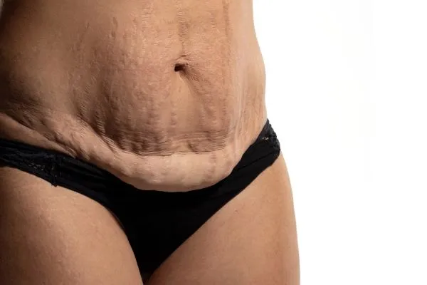 Lost the Weight but Not the Loose Skin? 1 image of womans stomach after weight loss showing loose skin Bletchley